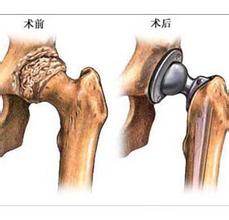 關(guān)節(jié)置換術(shù)前術(shù)后