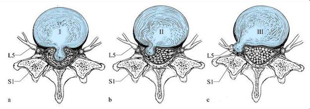 腰椎滑脫的分期