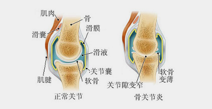 正常關(guān)節(jié)與關(guān)節(jié)炎關(guān)節(jié)對(duì)比