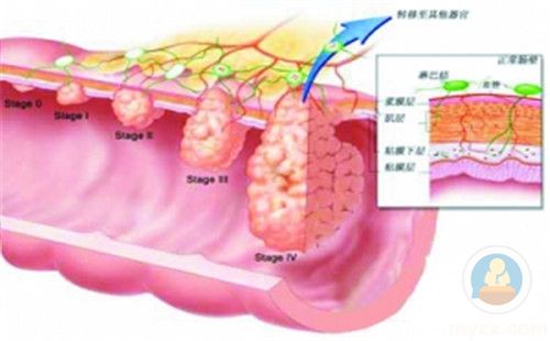 直腸癌分期圖