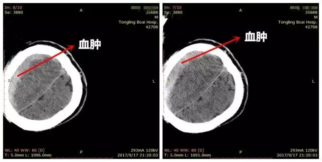 術(shù)前CT：箭頭所指白色部分為血腫區(qū)域