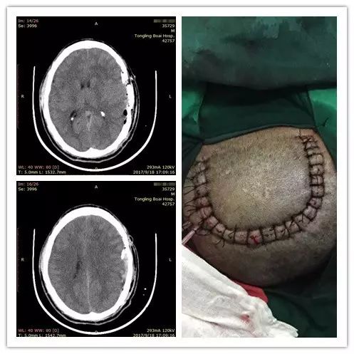 術(shù)后CT顯示血腫已經(jīng)清除