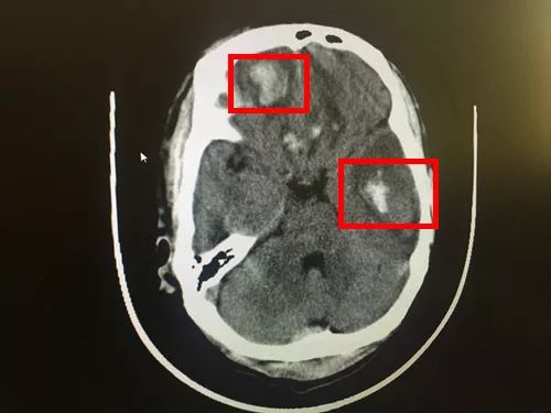 紅框處是患者腦部血腫的位置