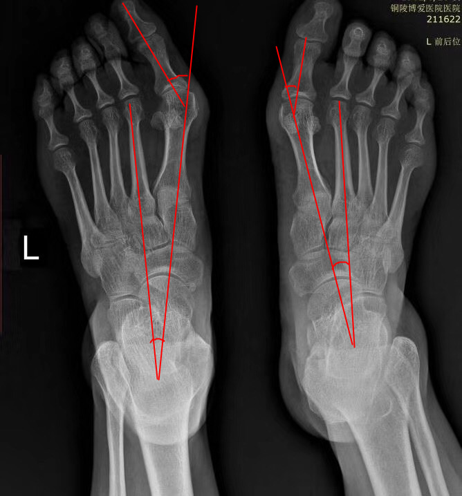 X片顯示患者左足拇外翻嚴重