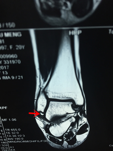 核磁可見腓骨遠端陳舊性撕脫性骨折