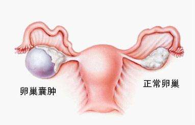 卵巢巧克力囊腫手術(shù)一例